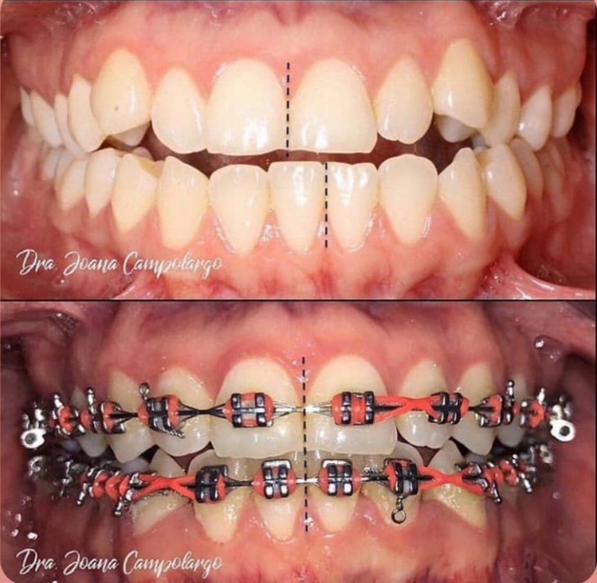 Before and After: Correction of misaligned teeth using Fixed Orthodontic Braces